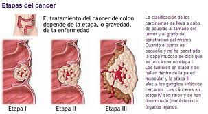 etapas del cancer