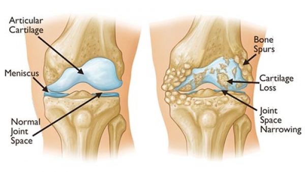 ¡Mil millones de personas sufrirán Osteoartritis en 2050!